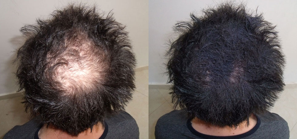 can scalp massages really regrow hair